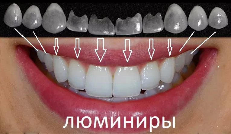 Тончайшие виниры - люминиры преображают зубы в крисивую улыбку, не повреждая эмали